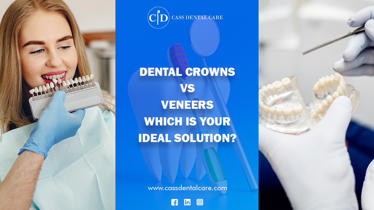 Dental Crowns vs. Veneers Which is your Ideal Solution
