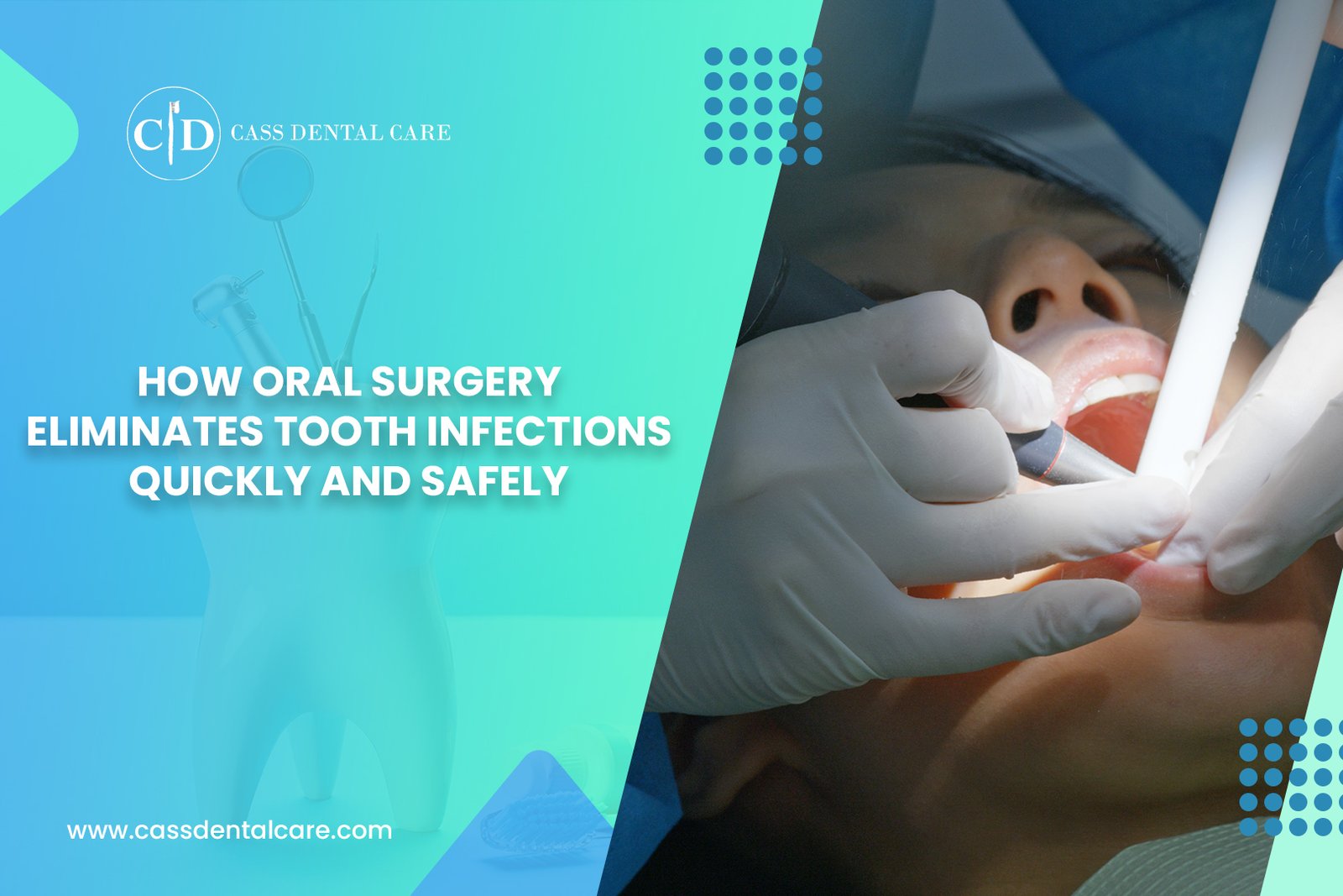 How Oral Surgery Eliminates Tooth Infections Quickly and Safely